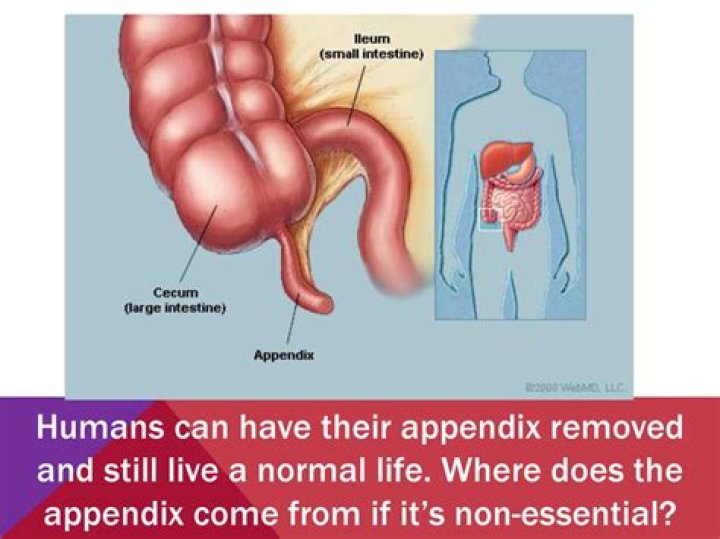 Can a person be born without an appendix