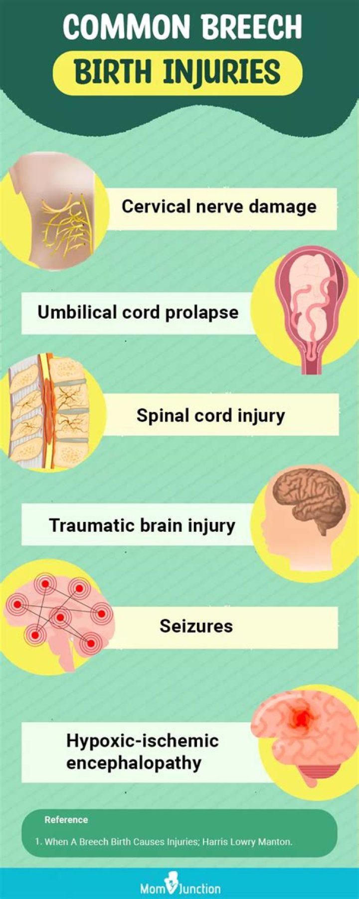 Characteristics of breech birth adults