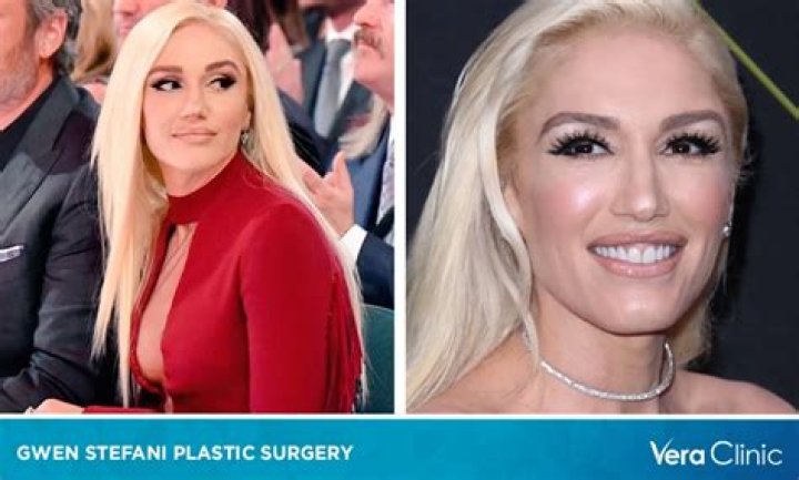 Did Gwen Stefani Undergo Plastic Surgery? Before and After Photos Explored