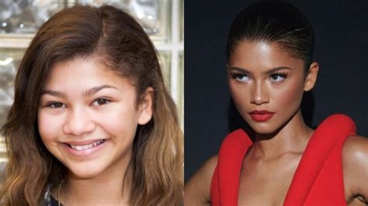 Did Zendaya Receive a Nose Job? The Untold Truth!