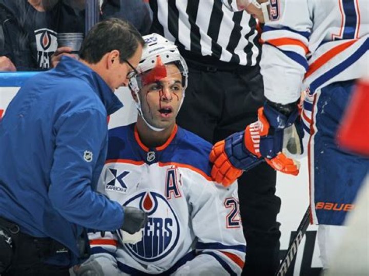 Does Darnell Nurse Have Vitiligo? Face Skin Disease- What Happened To The Ice Hockey Player