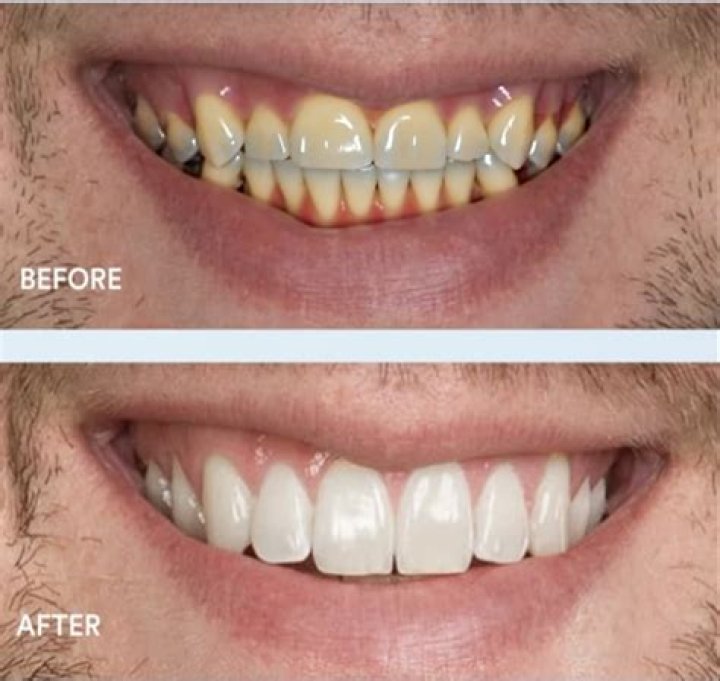 Does Freddie Freeman Have Fake Teeth or Veneers? Before and After Pictures