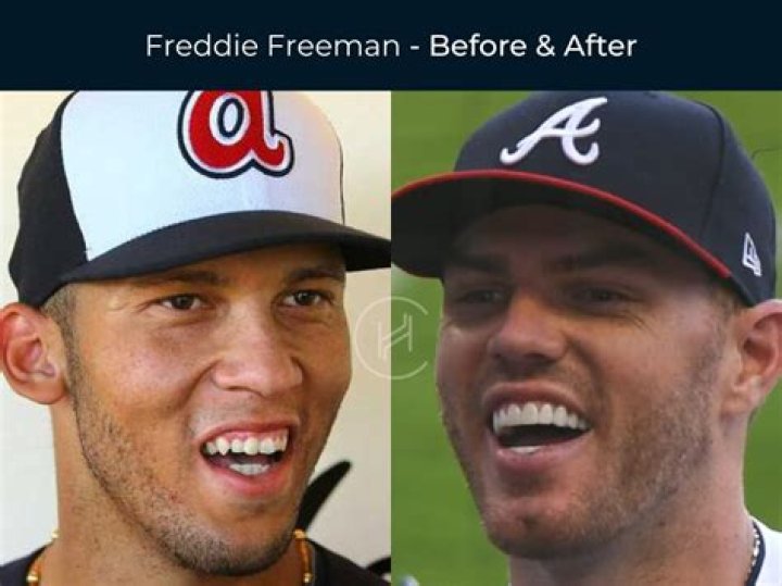 Does Freddie Freeman Have Veneers? Fake Teeth Rumors Of The American Baseball Player