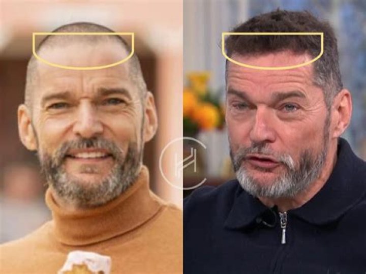 Has Fred Sirieix Had A Hair Transplant? Everything On His Daughter On Olympics And New Wife