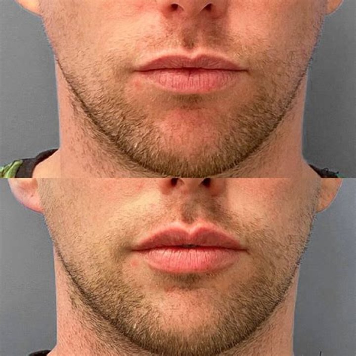 Has Gemma Owen Done Plastic Surgery? Fans Suspect 19-Year-Old Has Lip Filler