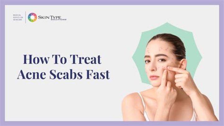 How to get rid of pimple scabs