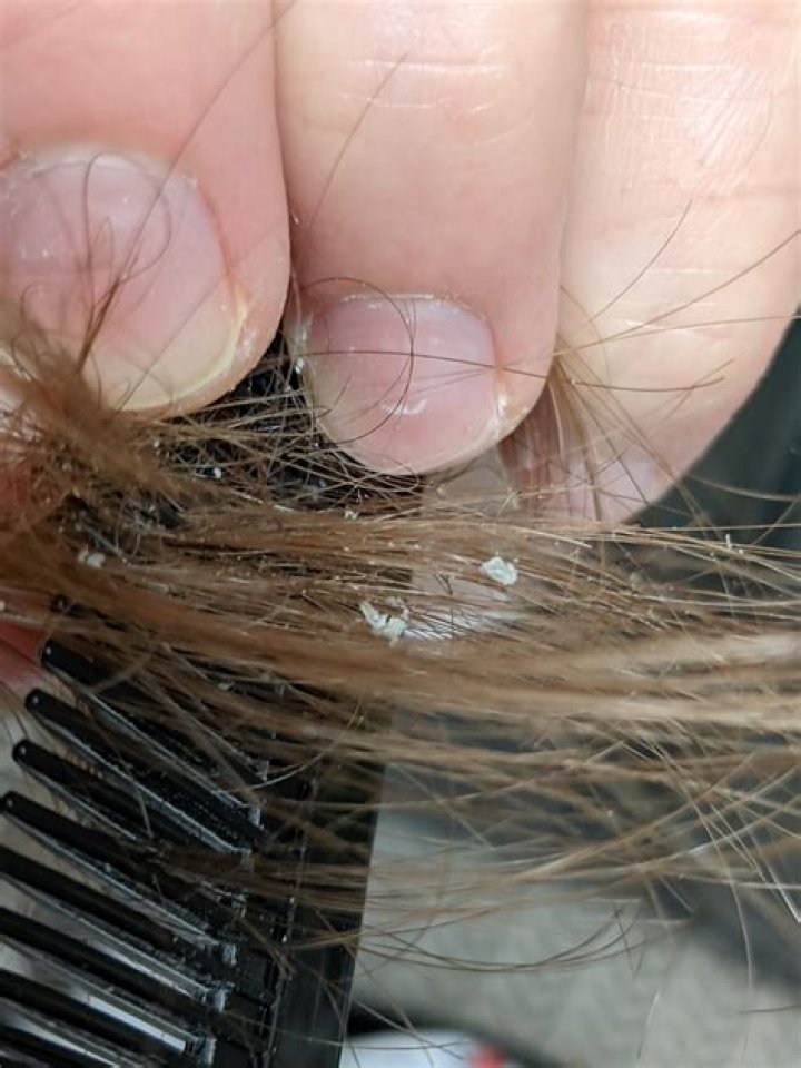 How to get rid of white piedra