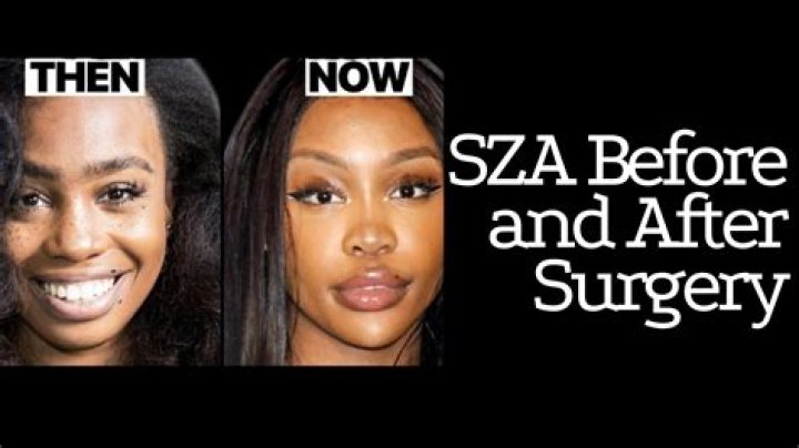 How Was SZA Before Surgery? Her Before And After Pictures Analyzed