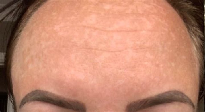 What Happened To Darnell Nurse’s Eyebrow? Skin Pigment Condition – Does He Have Vitiligo?