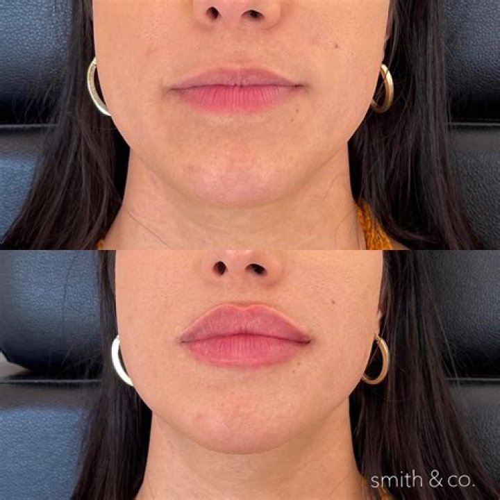 What Happened To Maren Morris Lips? Plastic Surgery Update, Before & After Photos From Instagram