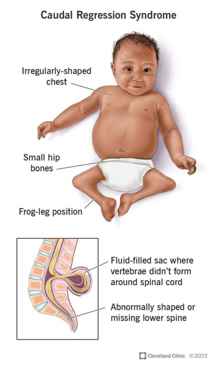 What Happened To Zion Clark? Story About His Caudal Regression Syndrome Disease