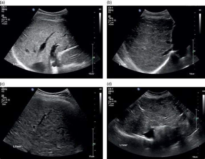 What is altered parenchymal echotexture