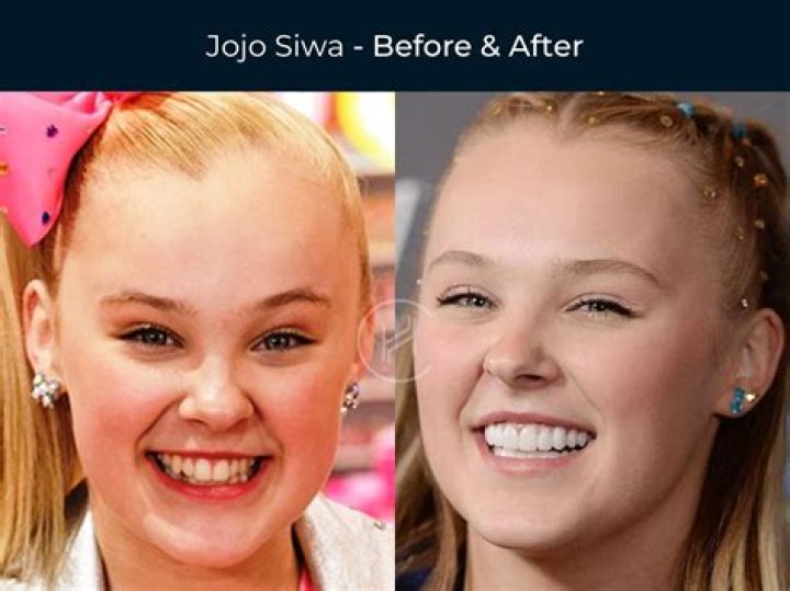 What’s Wrong With Gabi Butler Teeth? Before And After Fixing – Cheer